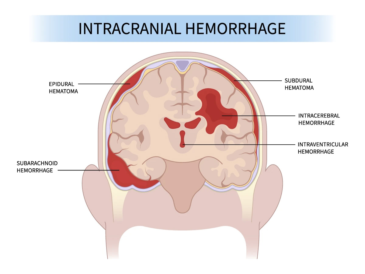 Antagonisation des anticoagulants oraux lors d'hémorragies intracrâniennes