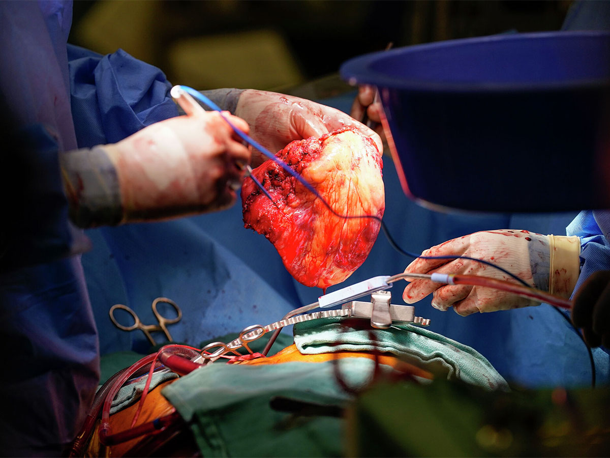 Nesseler Mansour review heart transplantation